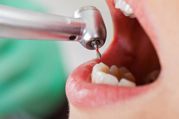Best Broken or Chipped Tooth Repair in Roan Mountain, TN